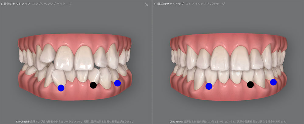 船堀ガーデン歯科・矯正歯科の部分矯正